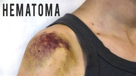 Home Remedies To Get Rid Of A Hematoma Youtube