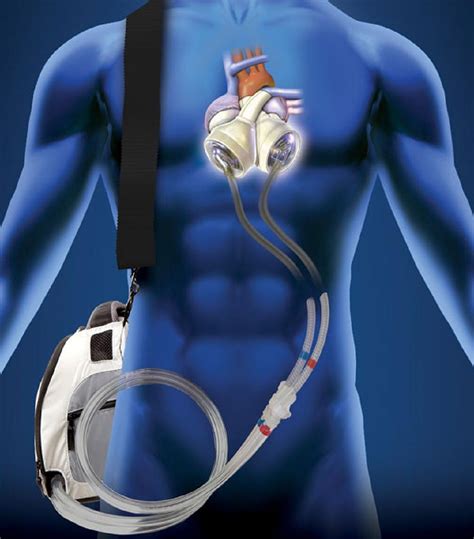 Total Artificial Heart Portable System