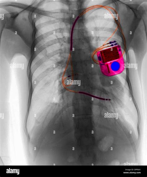 Chest X Ray Showing Pacemaker Stock Photo Alamy