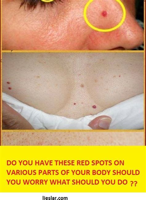 If You Have These Red Spots On Various Parts Of Your Body Should You