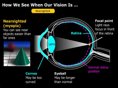 Myopia Jacksonville Gulani Vision Institute