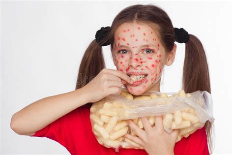 Front View Of A Girl With A Problem Skin Rash Stock Photo Image Of