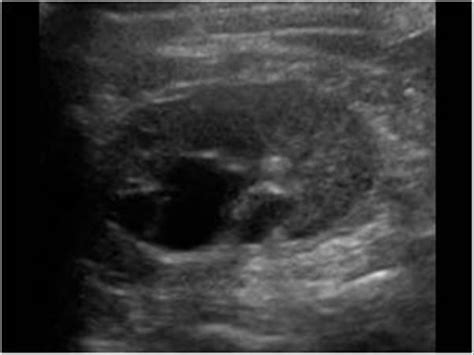 Parapelvic Cysts Transverse Reproductive System Ultrasound