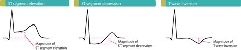 St Segment Depression In Myocardial Ischemia And Differential Diagnoses