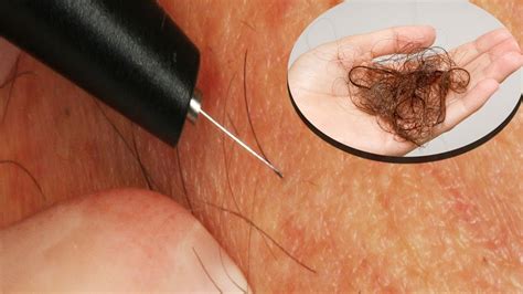 Ingrown hairs are hairs that curl and grow back into your skin after shaving or waxing. Removing Ingrown Hairs Before Electrolysis Session - YouTube