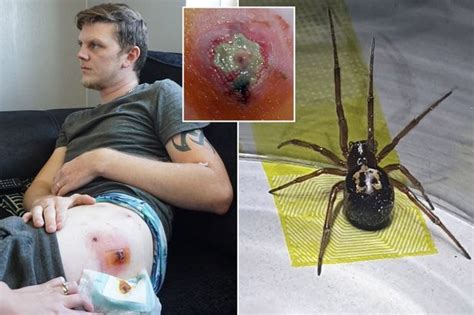 However, some stings can be painful and trigger a serious allergic reaction. Dad 'bitten five times by false widow spiders in bed is ...