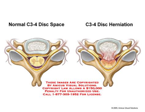 Amicus Illustration Of Amicus Injury Cervical Normal Disc Space C3 4 Herniation Central