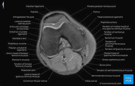 The muscles that affect the knee's movement run along the thigh and calf. Knee Muscle Anatomy Mri : Mri Knee Anatomy Knee Sagittal ...
