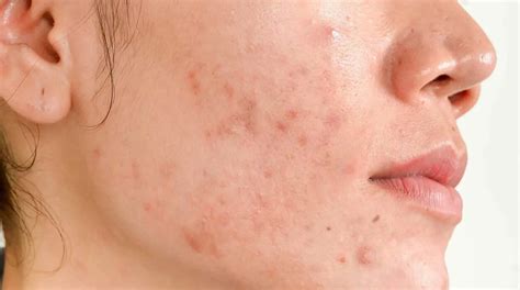 What Is Hormonal Acne And How To Address It Dr Linda Khoshaba