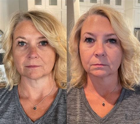 You Wont Believe These Complete Collagen Before After Photos