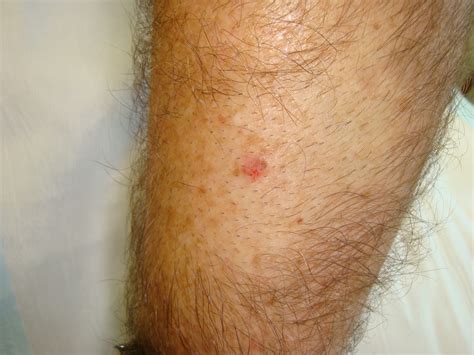 Consultations In Dermatoscopy Blues Revisited And A Leg Lesion