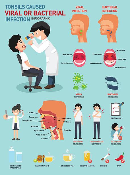 Tonsillitis Illustrations Royalty Free Vector Graphics And Clip Art Istock