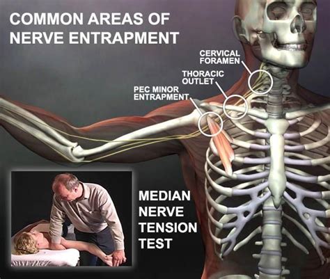 Median Nerve Compression Pathologies Median Nerve Massage Today My