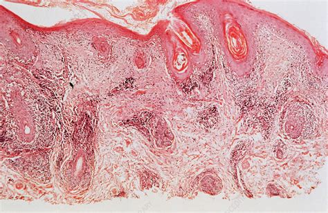 Discoid Lupus Erythematosus Lm Stock Image C0252601 Science