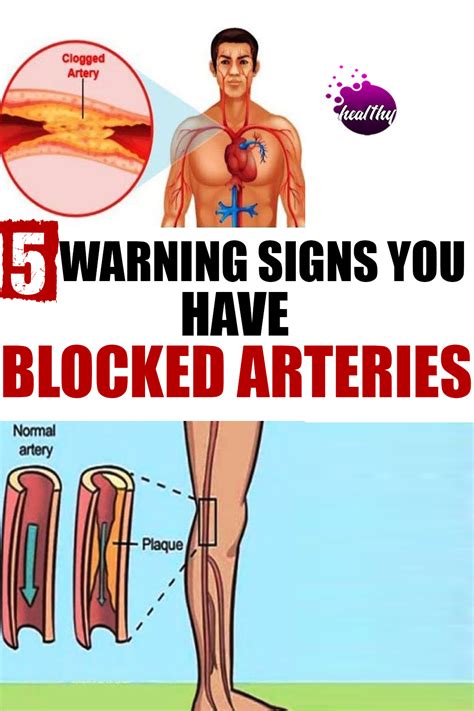 Here Are 5 Warning Signs You Have Blocked Arteries In 2020 Arteries
