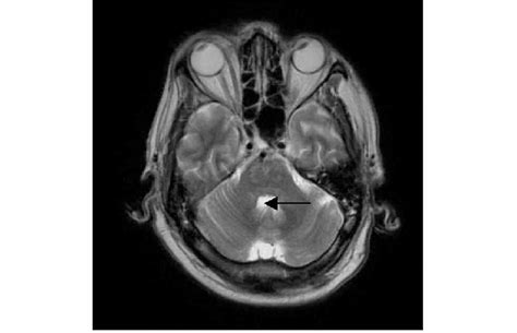 Magnetic Resonance Imaging Mri Of Patient Showing Lesions Typical