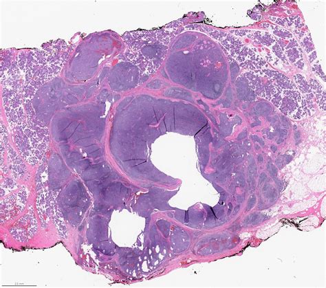 Pathology Outlines Myoepithelial Carcinoma