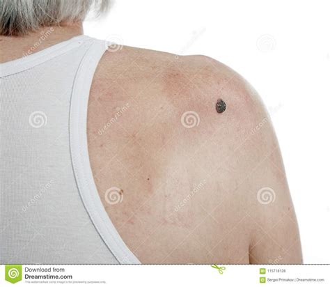 Skin Cancer In Men Stock Photo Image Of Medical Consultation 115718128