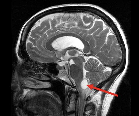 Hemangioblastoma Tricias Story Mayfield Brain And Spine