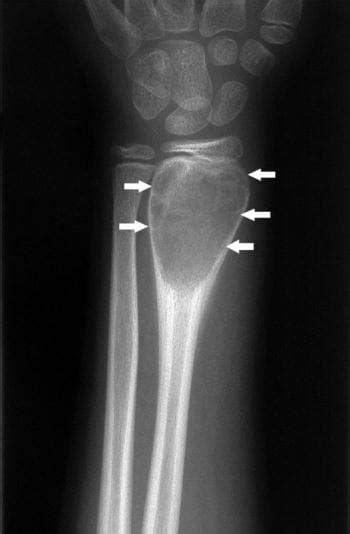 Can Benign Bone Lesions Cause Pain Exploring The Discomfort