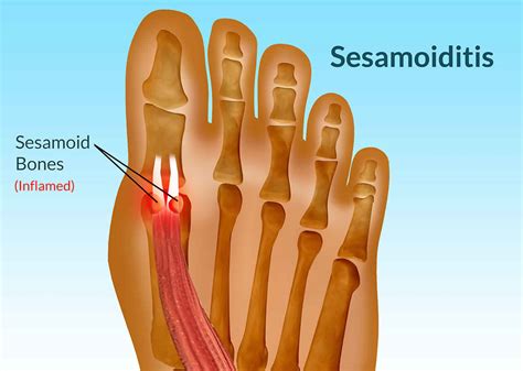 Sesamoiditis Causes Symptoms Diagnosis And Treatment