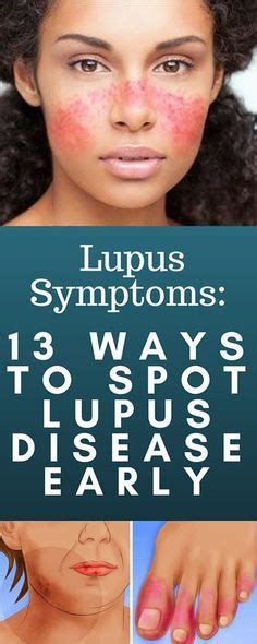 Lupus Symptoms 13 Ways To Spot Lupus Disease Early Lupus Symptoms Lupus