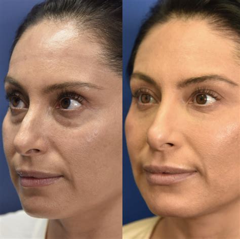 Beauty By Dr Kay Plastic Surgery Before And After Photos Under Eye
