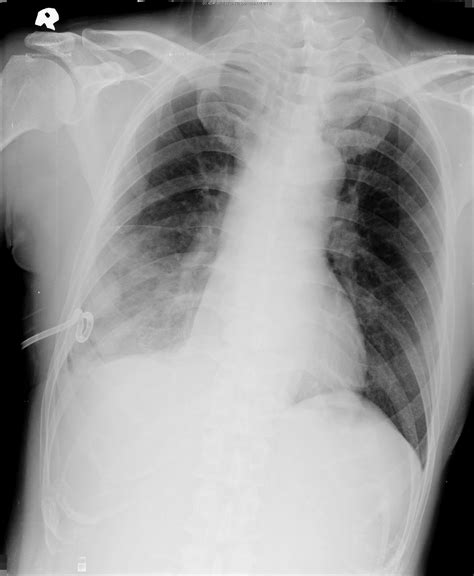 Pleural mesothelioma cancer is an uncommon cancer analyzed in individuals who have been presented to large amounts of asbestos.pleural mesothelioma. CXR 胸部x光判讀 malignant mesothelioma
