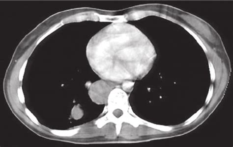 Chest Ct Scanning Image Of A Bronchogenic Cyst In The Posterior