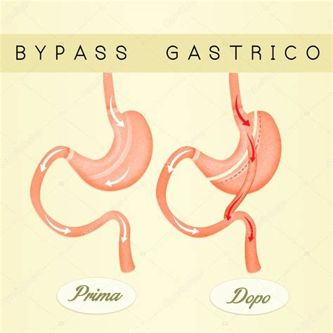 Illustration Of Gastric Bypass Stock Photo By ©adrenalina 122655260