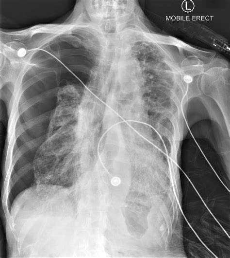 Chest X Ray Showing Large Right Pneumothorax And Small Pleural Effusion My XXX Hot Girl