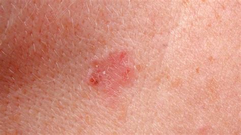 Images Of Basal Cell Carcinoma Pictures Diagnosis And More