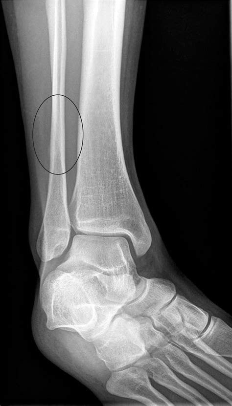 Fibula Stress Fracture Mri Images And Photos Finder