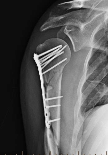 Proximal Humerus Fracture Broken Humerus Reno Orthopedic Center