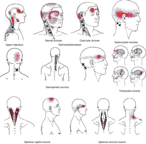 Массаж триггерных точек при головных болях фото презентация