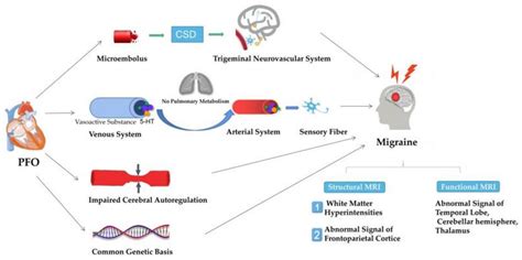 Brain Sciences Free Full Text The Patent Foramen Ovale And Migraine