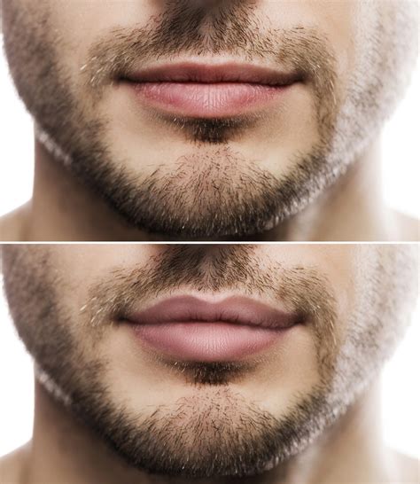 The Men Getting Lip Fillers Sk N Clinics