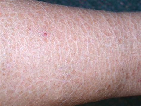 Ichthyosis Vulgaris Treatment Dorothee Padraig South West Skin Health