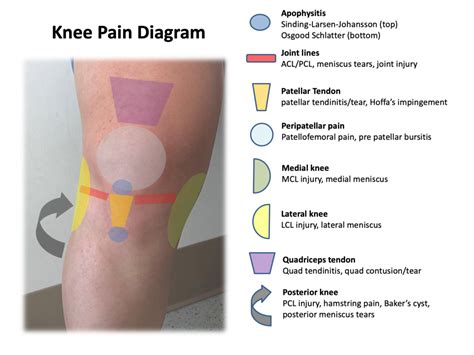 Inside Knee Pain Diagnosis Chart