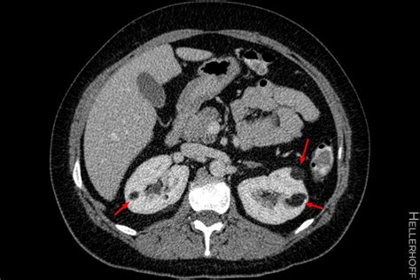 Benign Kidney Tumors Shrink With Mtor Inhibitor Medpage Today
