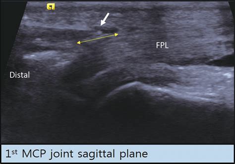 A Sagittal View Of The A1 Pulley In The Right Thumb Arrow Indicates