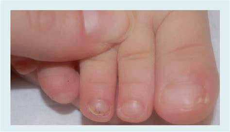 Nail Psoriasis Of The Third Right Toenail Onycholysis With