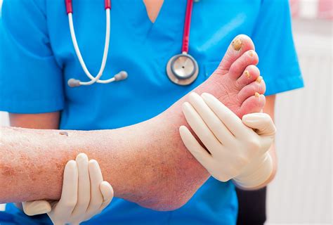 Cellulitis Causes When To Worry What To Do Emedihealth