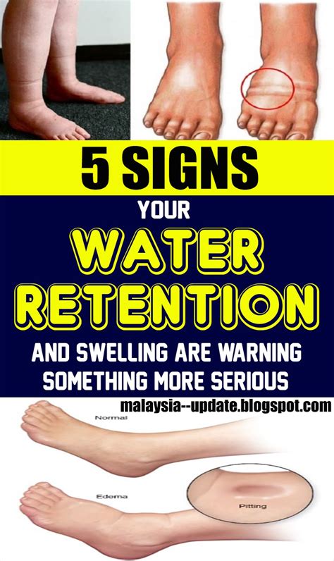 Water, or fluid, retention occurs when there is a problem with one or more of the body's mechanisms for maintaining fluid levels. 5 Signs Your Water Retention and Swelling Are Warning ...