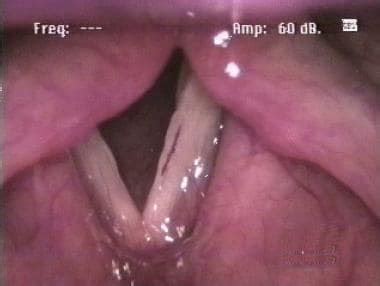 Vascular Lesions Of The Vocal Fold Practice Essentials Problem