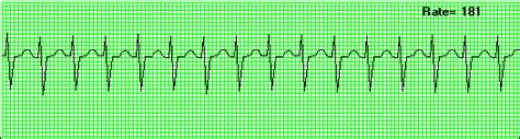 Response to adenosine by itself does. Micro EKG - Mad Scientist Software