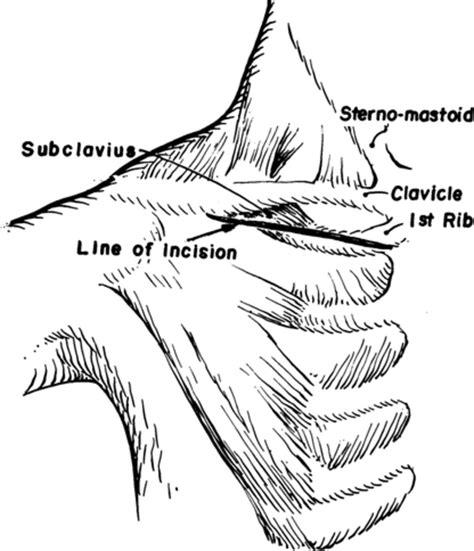 Relief Of Costoclavicular Syndrome By Infraclavicular Removal Of First