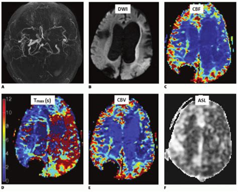 Brain Mr Perfusion Imaging Cerebral Ischemia Radiology Key