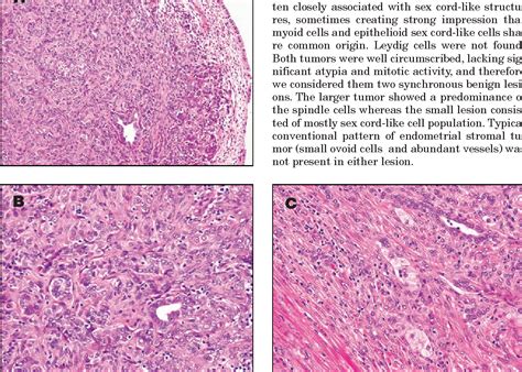 Figure 1 From Uterine Tumor Resembling Ovarian Sex Cord Tumor Utrosct Report Of Case