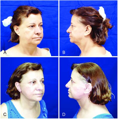 N A And B Preoperative Appearance Of Secondary Rhytidectomy Associated